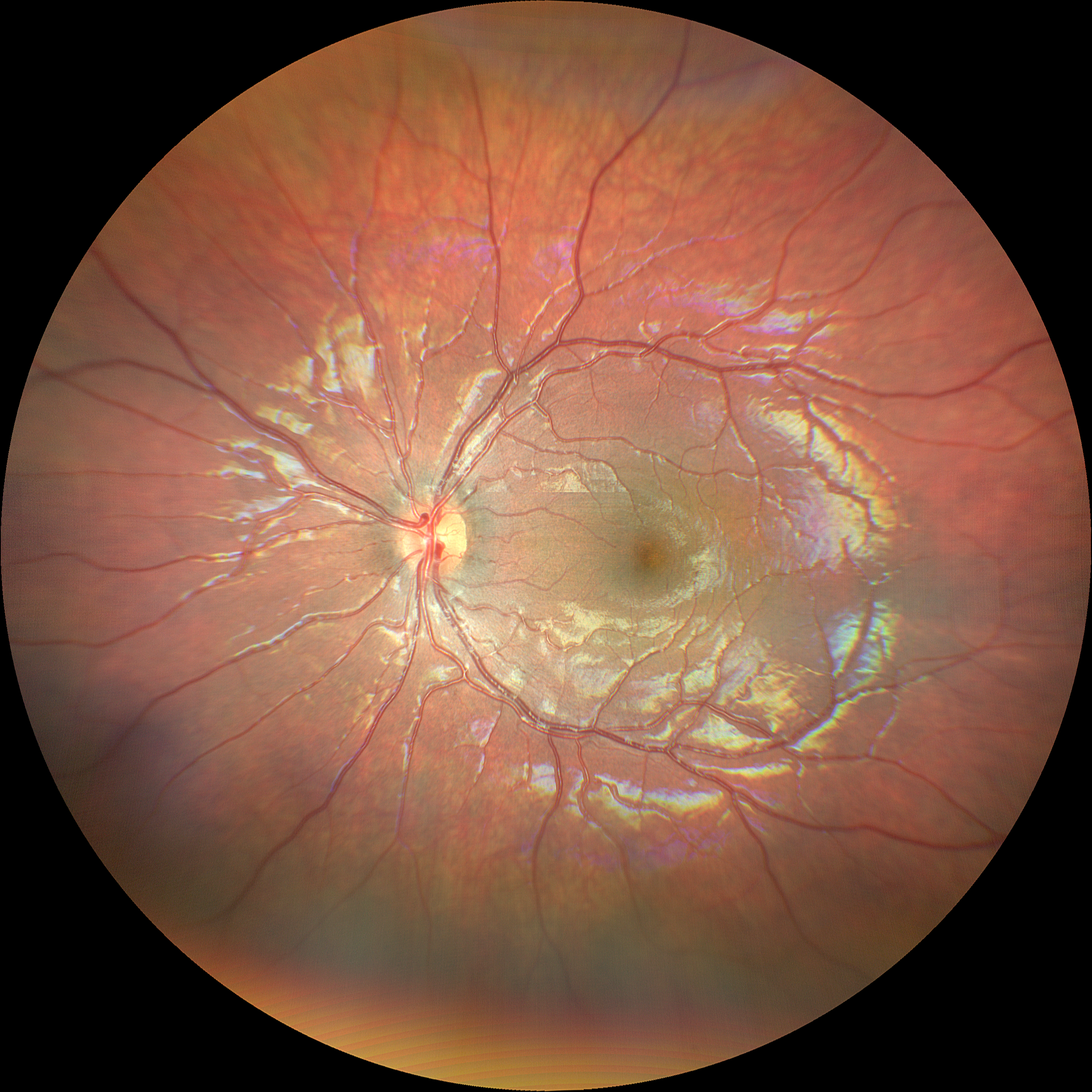 Imaging retinico ad ampio campo in bimbo di 12 mesi